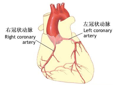 冠状动脉造影与支架放置示意图(1)